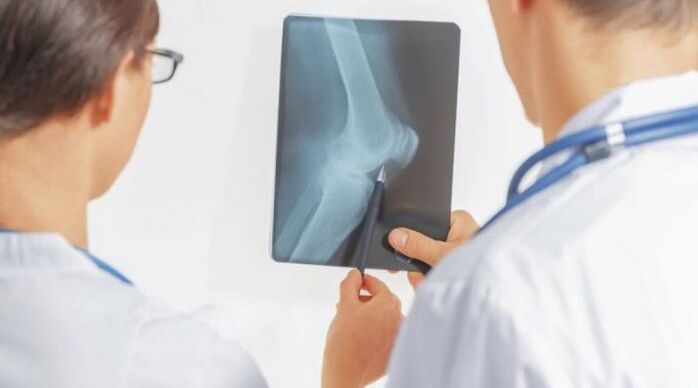 Po nevyhnutnej diagnostike artrózy kolenného kĺbu lekári predpisujú komplexnú liečbu
