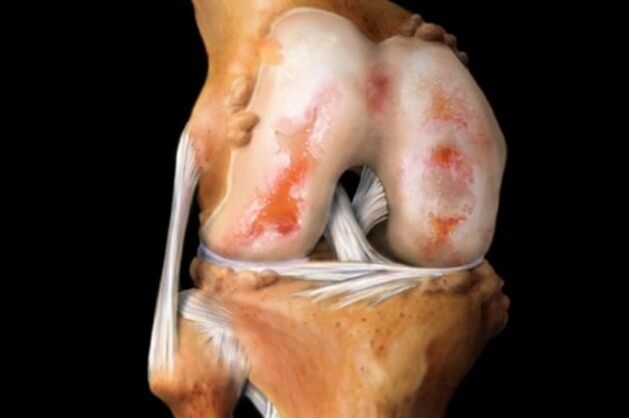 Zničenie kolenného kĺbu v dôsledku artrózy - bežná patológia muskuloskeletálneho systému