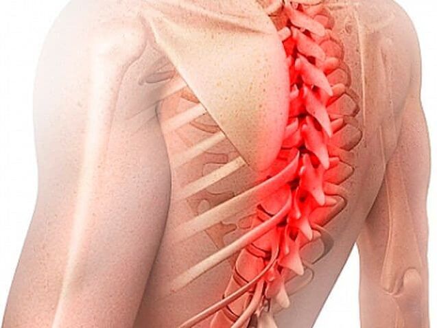 Osteochondróza hrudnej chrbtice je zriedkavou formou ochorenia
