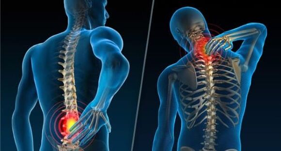 Známky naznačujúce vývoj osteochondrózy - bolesť v krku a dolnej časti chrbta
