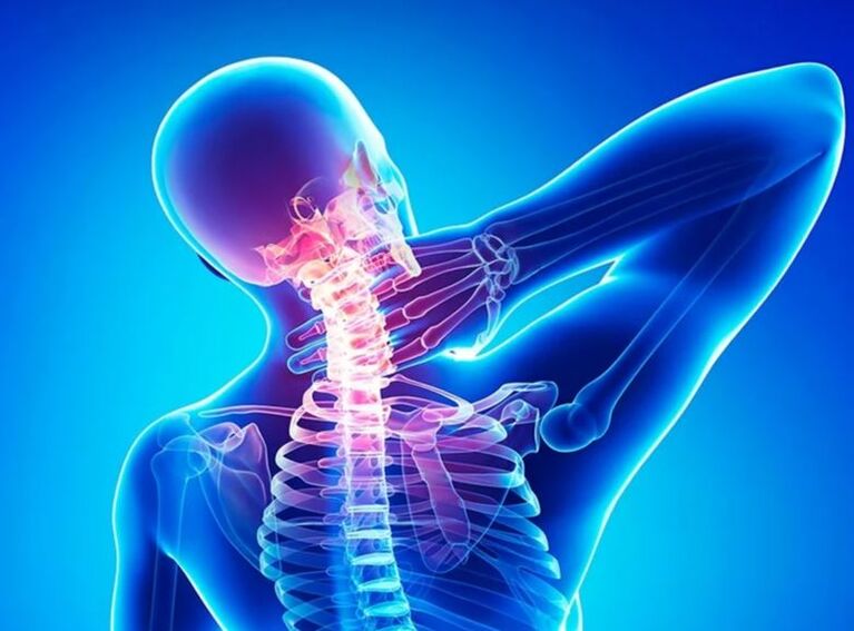 Osteochondróza krčnej chrbtice