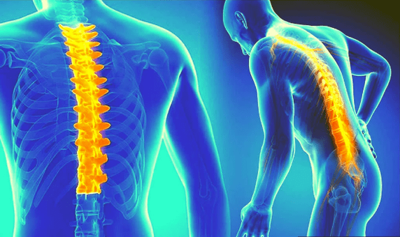 Osteochondróza chrbtice