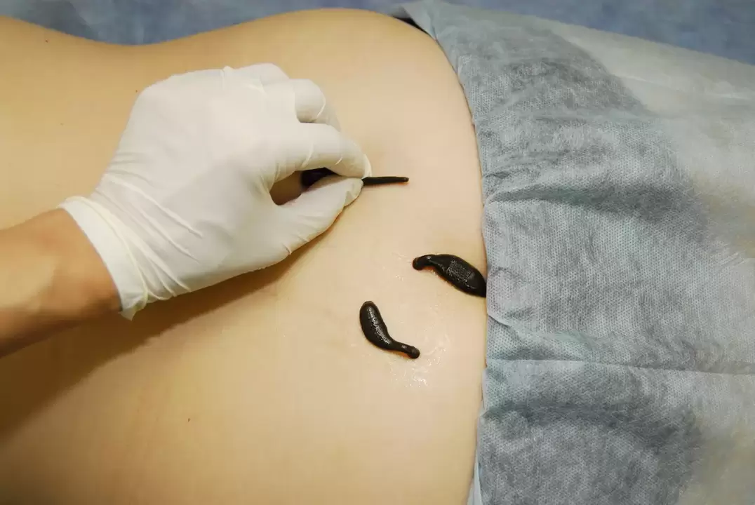 umiestnenie pijavíc pre bedrovú osteochondrózu