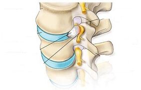 hlavné príznaky cervikálnej osteochondrózy