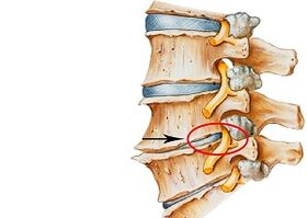 príčiny cervikálnej osteochondrózy