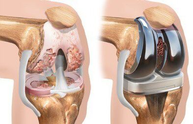 Endoprotetika kolenného kĺbu s gonartrózou